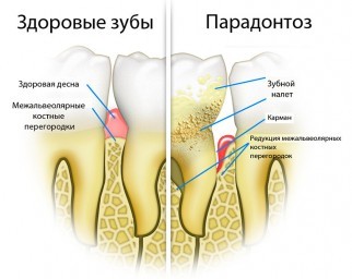 Пародонтоз и методы борьбы с ним